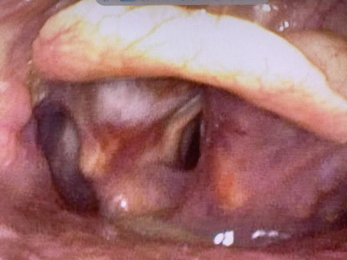 #viewfromthecrew Supra and infraglottic laryngeal carcinoma, as seen with  flexible endoscopy. Not a lot of space for a tracheal tube…@jducanto @DaveOlvera1 @airwayGladiator @EBMgoneWILD @cliffreid