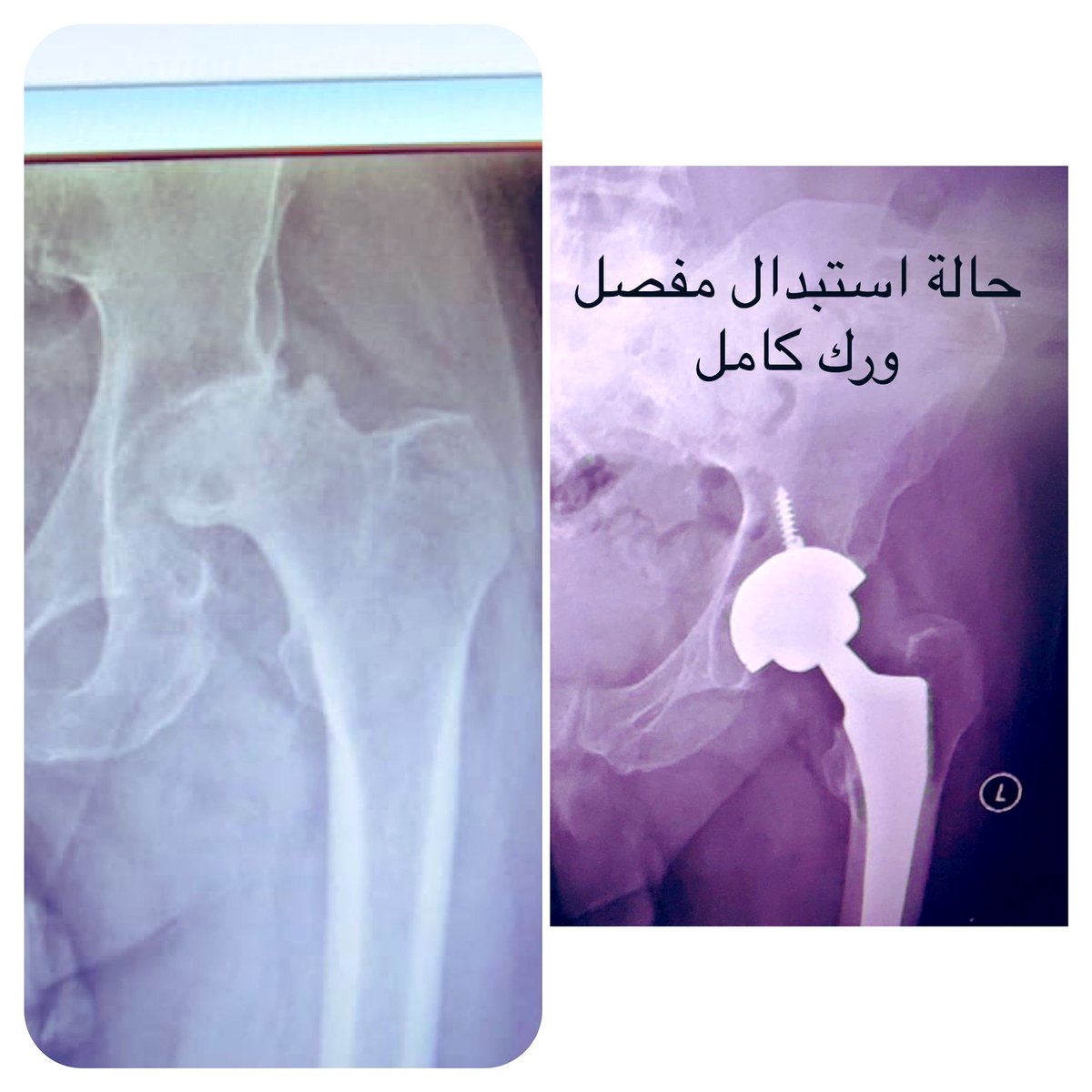 dr_ruwaili's tweet photo. procedure century
استبدال مفصل الورك من انجح العمليات لإزالة الم احتكاك مفصل الورك. 
عمليات تمت خلال ال 3 اسابيع الماضيه بوحدة استبدال المفاصل الصناعية والإصابات الرياضية في @aljouf_hospital بالإضافة الى عدد كبير من حالات المناظير والاصابات الرياضية.
مع الزملاء @AHMEDANAZI و @BandarNMA