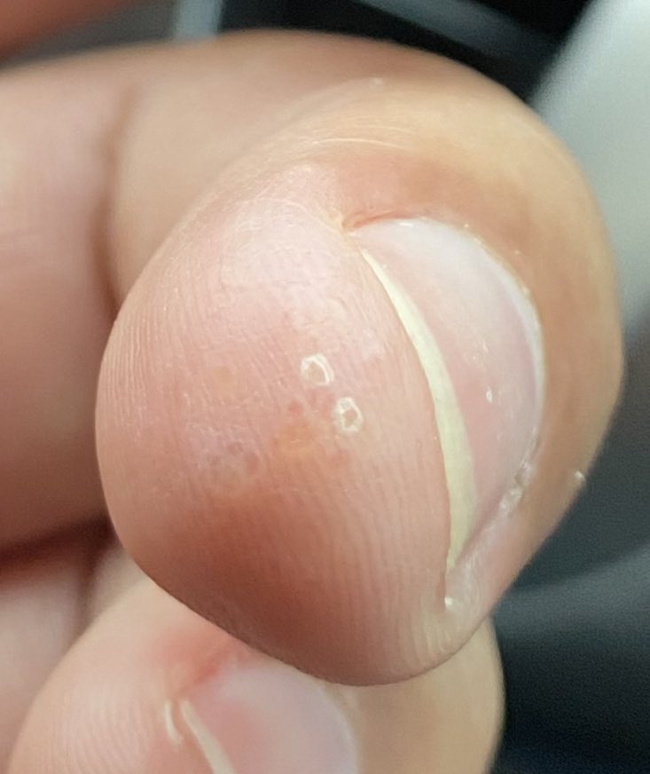 Patient with enlarged liver and spleen presents with small blisters in all fingertips. What’s the diagnosis? #WithConsent