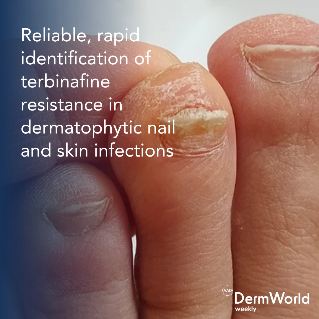 AADmember's tweet photo. .@TheJEADV study identified the incidence of terbinafine resistance among a large cohort of Trichophyton rubrum and Trichophyton mentagrophytes/Trichophyton interdigitale isolates. https://t.co/hfVRuIR0g6 #DermWorldWeekly https://t.co/ZFfisLt4rS