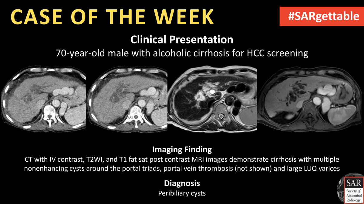 The answer to last week's #SARgettable Case of the Week, submitted by @kchang, is: Peribiliary cysts. Thanks for playing!