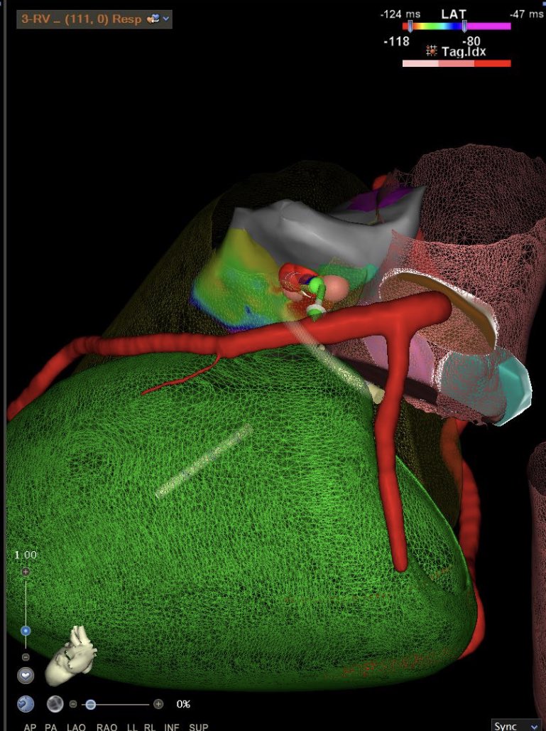 Checcodes80's tweet photo. #epeeps Another puomonary valve-related VT. Using ICE we clearly appreciate most of these arrhythmias comes from pulmonary valve sleeves. See our  new classification of RVOT-VAs ! @FilippoCauti @shivkumarmd @EPeeps_Bot 
https://t.co/tSOKUD5K7Z https://t.co/uopJeq2k2c