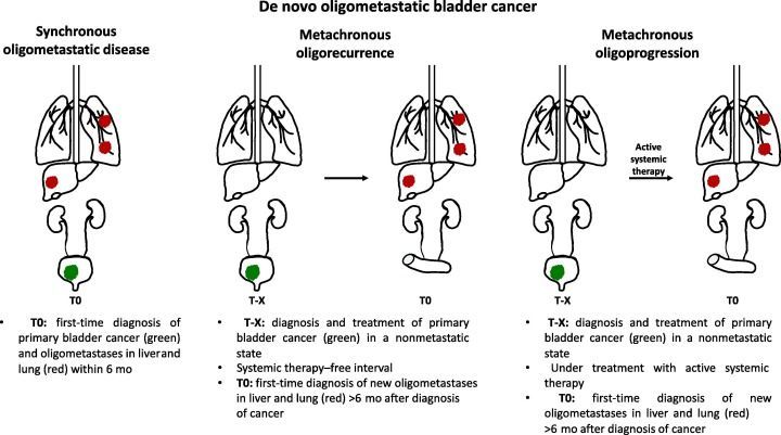 Definition and Diagnosis of Oligometastatic Bladder Cancer: A Delphi Consensus Study Endorsed by the European Association of Urology, European Society for Radiotherapy and Oncology, and European Society of Medical Oncology Genitourinary Faculty 

buff.ly/3QloUdT
