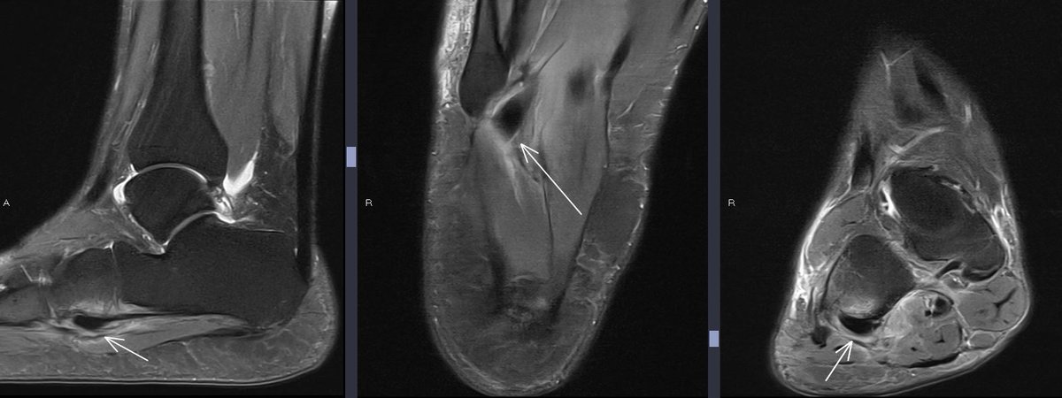themskarchive's tweet image. 18/10/2023. Instability. Peroneus longus tendon friction syndrome:  tendinopathy + cuboid peronal sulcus bone marrow edema + tenosinovitis and peritendinitis. #foot #MRI #instability #pain #MSK #orthotwitter #rehabilitation