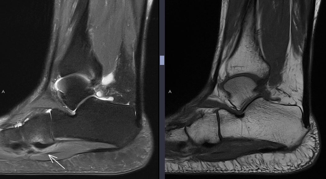 themskarchive's tweet image. 18/10/2023. Instability. Peroneus longus tendon friction syndrome:  tendinopathy + cuboid peronal sulcus bone marrow edema + tenosinovitis and peritendinitis. #foot #MRI #instability #pain #MSK #orthotwitter #rehabilitation