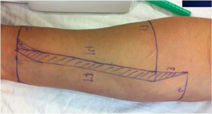 yoursexmedjour's tweet image. Bioengineered dermal matrix (@integra_life®) reduces donor site morbidity in total phallic construction with radial artery forearm free-flap👉rdcu.be/doRkI

@drMarcoFalcone1 @paolo_gontero @MaxTimpano @FedericaPeretti @SocietyGURS @essm_tweets @DocBlecher @N_Plamadeala