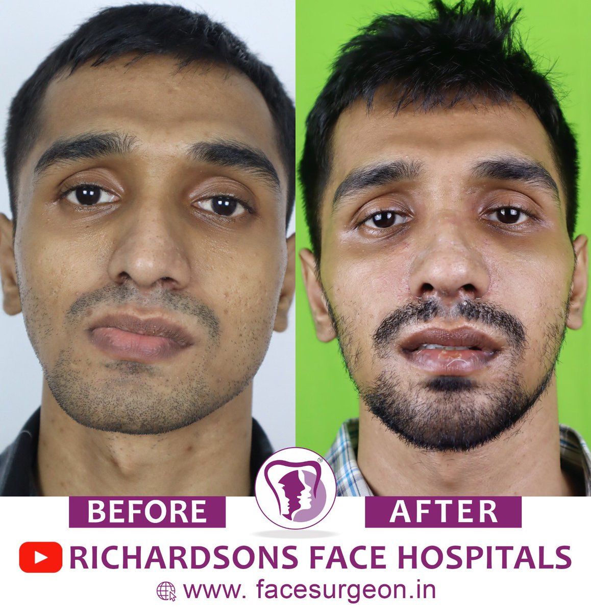 Case of Facial Asymmetry corrected at Richardsons . Check out the before after 👇👇👇 #face #asymmetry #maxfax #hospital #plasticsurgery #