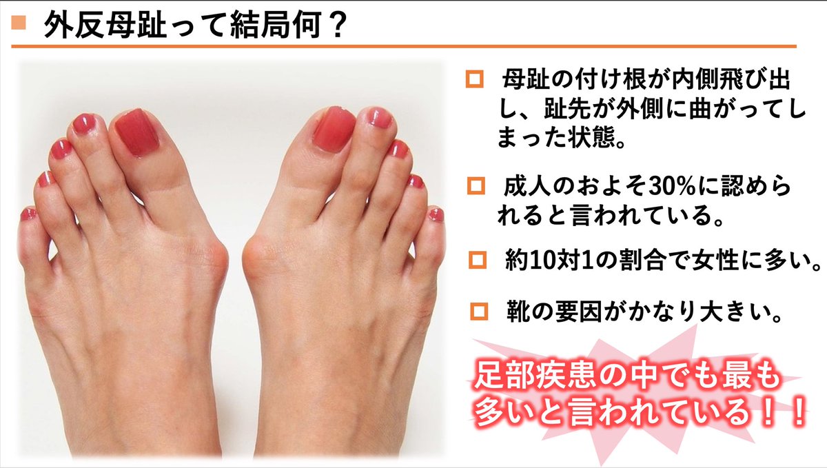 外反母趾の間違った解釈🦶 市民講座などでよくご質問 いただく