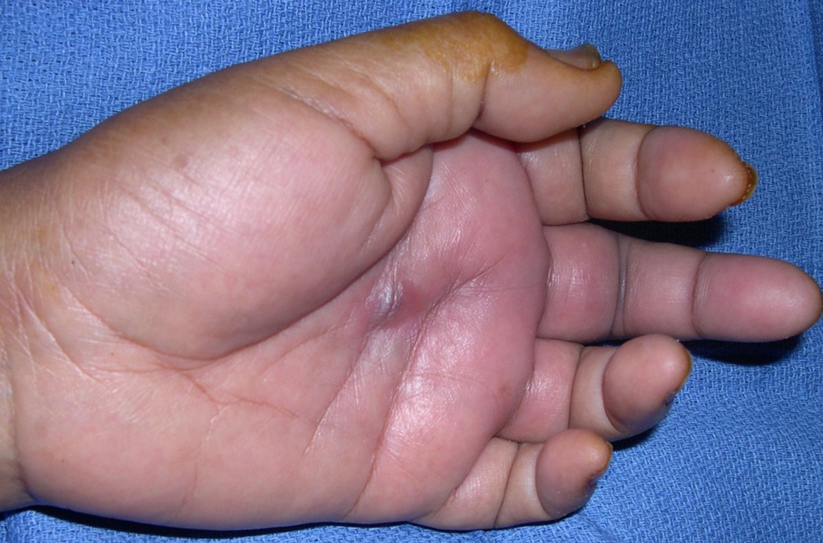 42F has tenderness around the palm and finger area, noticeable swelling, and discomfort when her hand is gently extended. What’s going on here and how would you treat this?

#LearnwithAAOS and earn #CME and #SAE for #MOC: bit.ly/2IIlLV7
