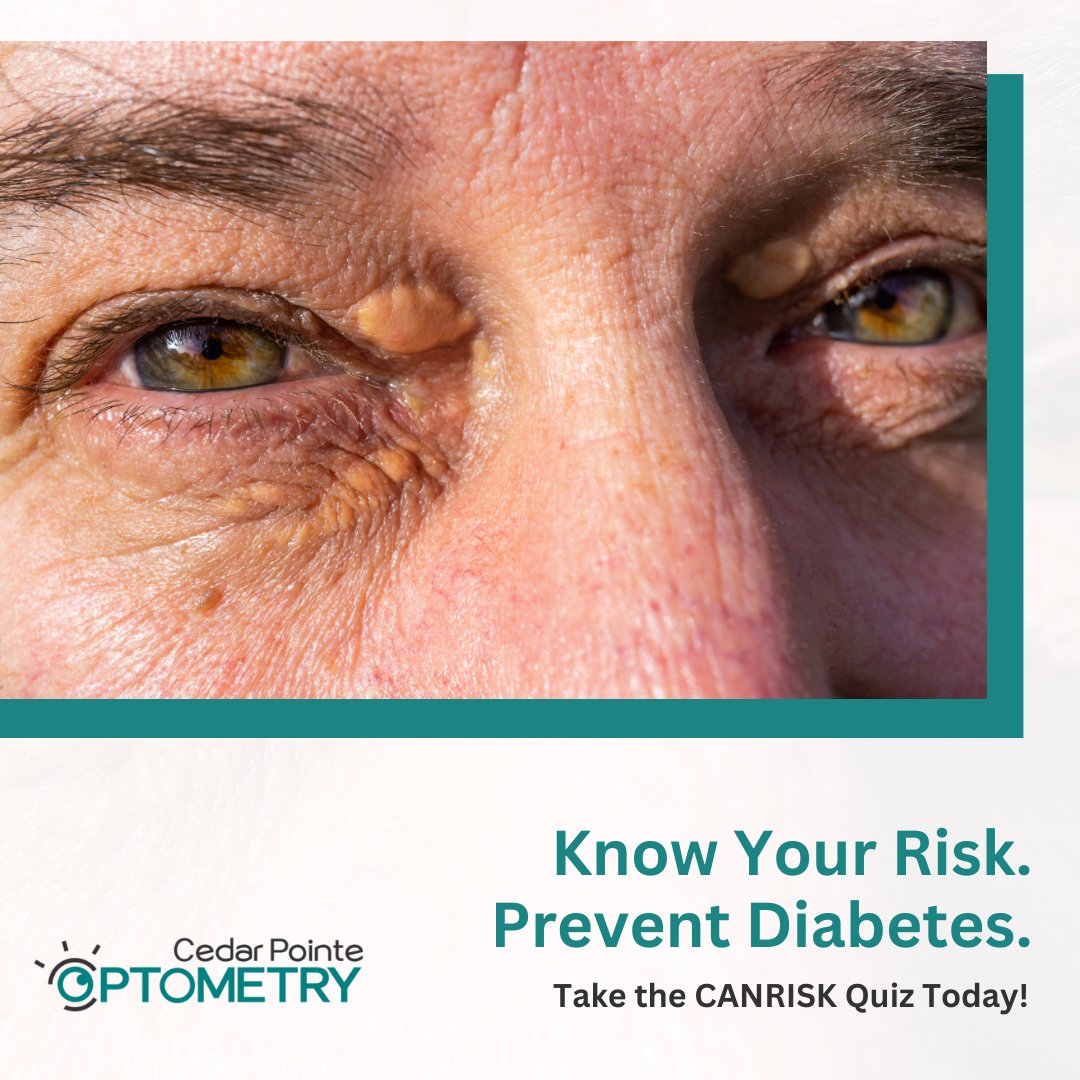 👁️ Your eyesight & diabetes are closely linked! Know your risk & make healthier choices today. Curious? Take the CANRISK quiz: 🔗 healthycanadians.gc.ca/en/canrisk 💙🔍
#EyeHealth #DiabetesAwareness #KnowYourRisk #CANRISKTest