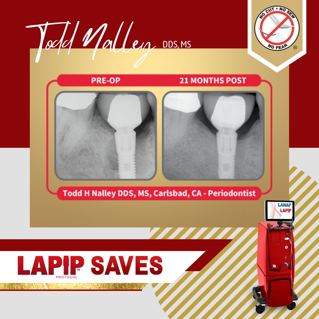 PerioLase4LANAP's tweet photo. The LANAP protocol only with the #PerioLase MVP-7 precisely targets diseased tissue while sparing healthy gums. The result? Reduced patient discomfort, faster recovery &amp; #TruePeriodontalRegeneration, elevating the standard of periodontal treatment. #Dentistry #LANAP #LANAPworks https://t.co/AqfjZaed8y