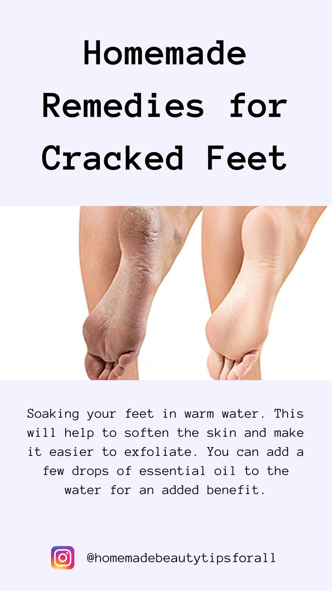 TipsHomemade's tweet photo. Homemade Remedies for Cracked Feet

#crackedfeet #feetcare https://t.co/uS37Ky2WtG