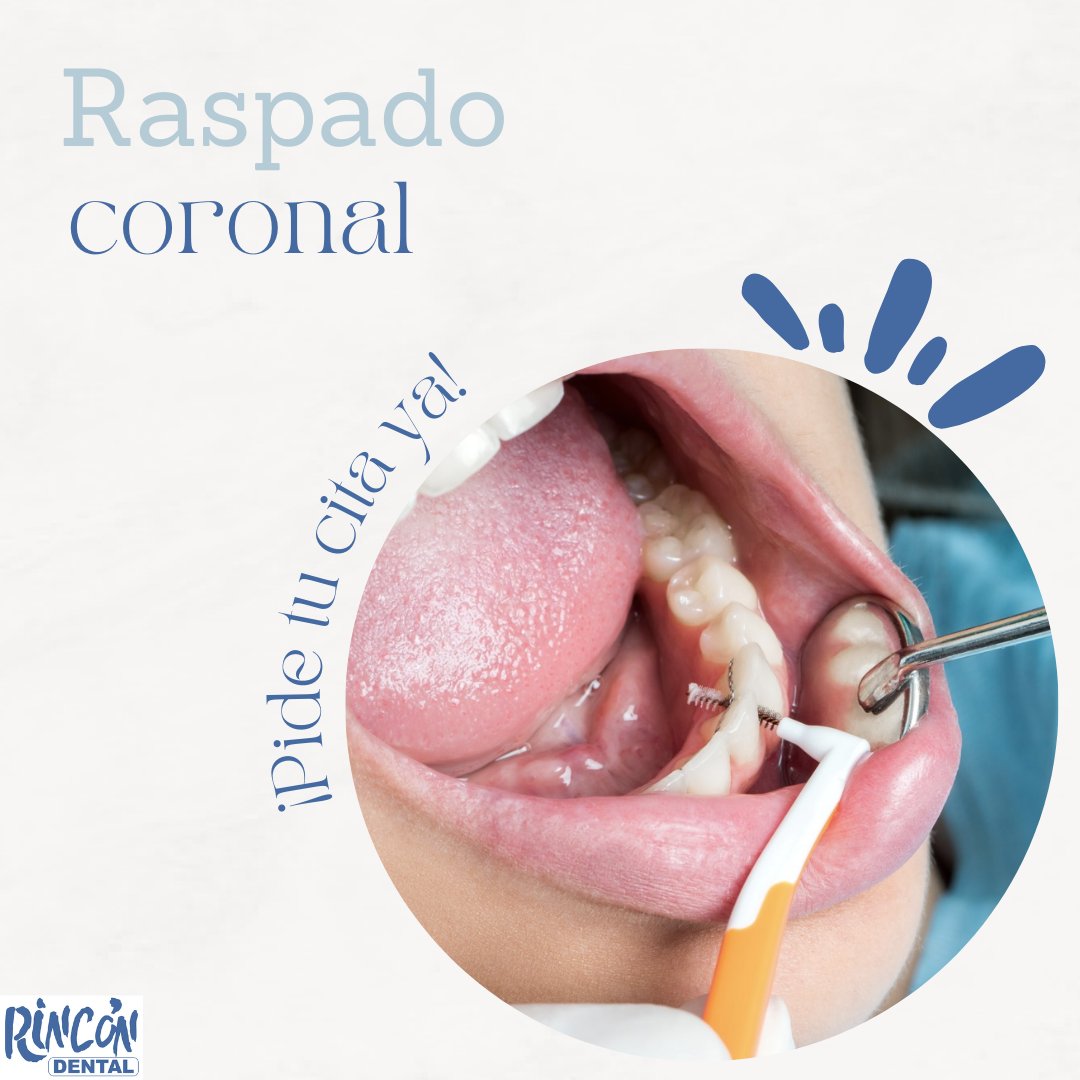 🦷  ¡Cuida tu sonrisa con el raspado coronal! Cuando el sarro se alza sobre las encías, la tartrectomía es la clave.

Es una limpieza dental profunda que mantiene tu boca en su mejor forma. ¡Programa tu cita hoy mismo para una sonrisa radiante!

📞900 52 52 84

#limpieza #dental
