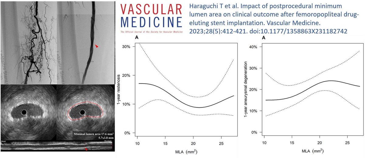 VMJ_SVM's tweet photo. From the current issue: Haraguchi et al. study the association of postprocedural minimum lumen area with clinical outcomes after femoropopliteal drug-eluting stent implantation. https://t.co/RZcDTIj3F7
#PAD #VascularTwitter https://t.co/FQL43DFSBc