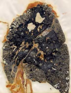 Which disease can cause black lung ?