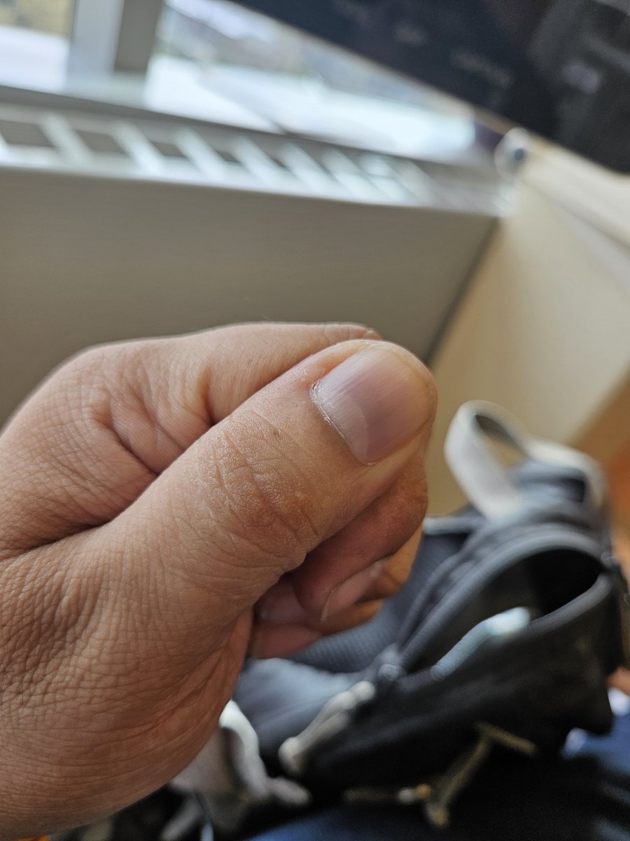 CristianKnight's tweet image. W11:S6 pigmentations setting in now from the infusions. Skin popping up with some dark spots and finger nail beds turning black. But we doing this for the long haul. May your days be bright today, much love to ya all. #appendixcancer #StrengthInUnity #love #kickcancersbutt