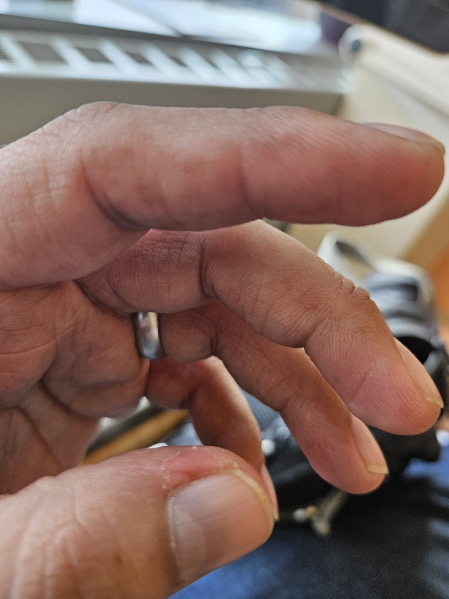 CristianKnight's tweet image. W11:S6 pigmentations setting in now from the infusions. Skin popping up with some dark spots and finger nail beds turning black. But we doing this for the long haul. May your days be bright today, much love to ya all. #appendixcancer #StrengthInUnity #love #kickcancersbutt