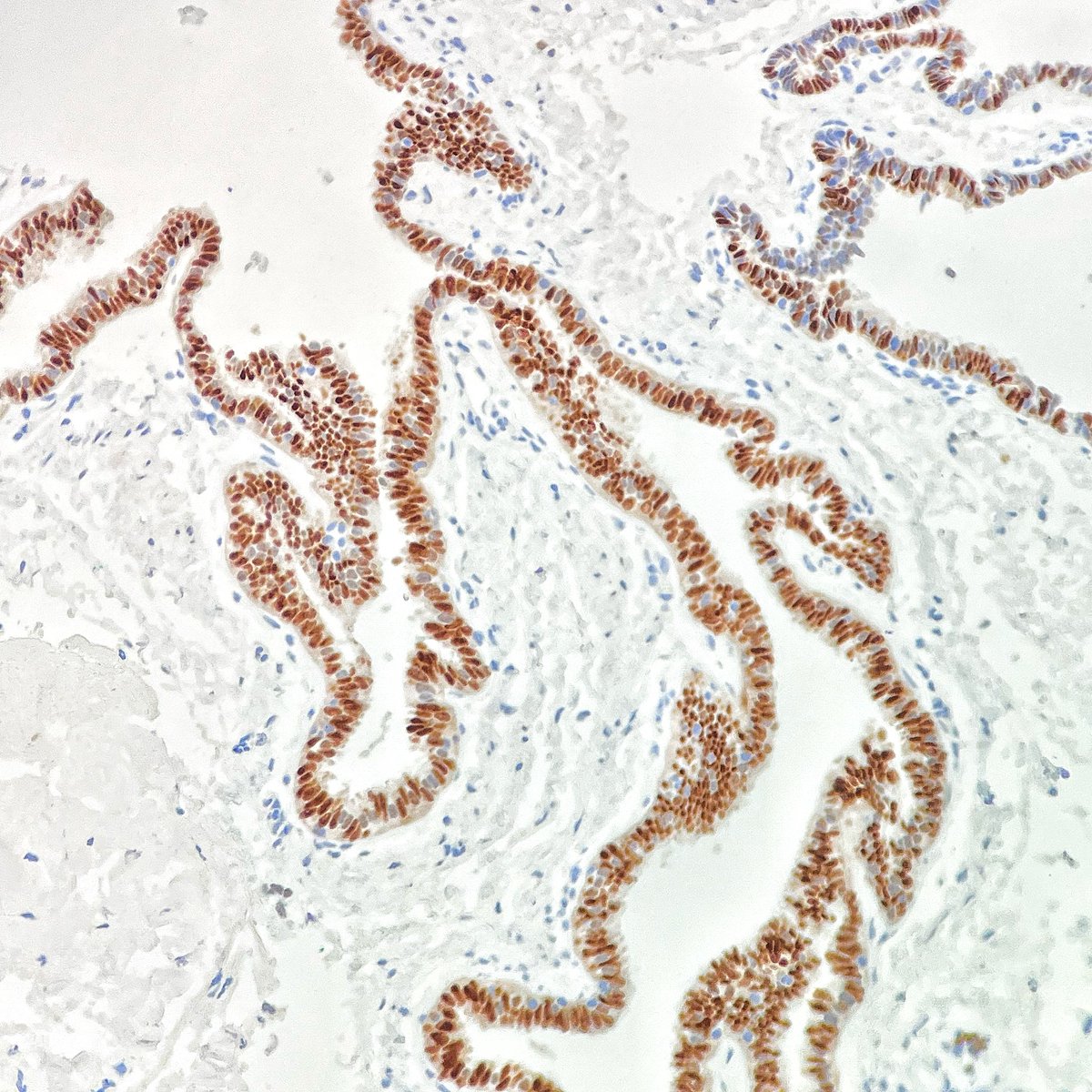 Intersting and rare!
Posterior mediastinal Mullerian cyst, aka cyst of Hattori,  in a 39 year-old female w chest pain 

IHC: PAX-8👇🏼, ER, PR strong and diffusely + 🔬 
#ThoracicPath #pathX  #PathTwitter