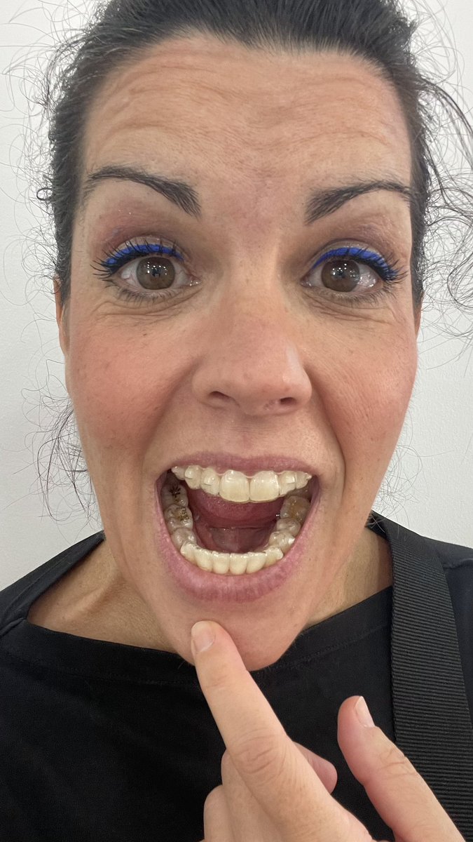 miotraella's tweet photo. Esto también lo subiré a Instagram. 
Pero aquí es la inmediatez. 
Se me ha partido la muela 47. 
Me queda más de un año de #invisaling 
Sentimientos encontrados con mis piños. 
Me gustaban torcidos. 
Me metieron miedo. 
Ya no hay vuelta atrás. 
Vayamos palante 🦷 https://t.co/g6rNbXILUW