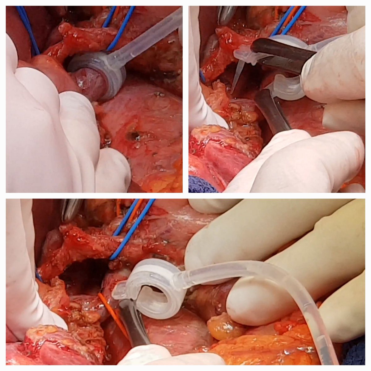 I have perhaps the solution to modulate the portal flow in Rapid Procedure ! I created this ring 5 year ago : no interest in Small For Size Syndrom after hepatectomy BUT new horizon for it in RAPID !! @ISLS2023 @_ILTS_ @ESOTtransplant @dbalci @hpb_so @sapisochin @ILLS_LAPLIVER