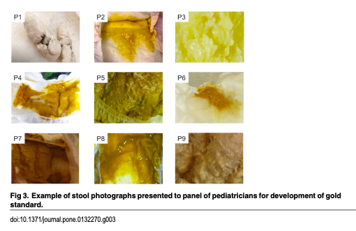 MARmPNP's tweet photo. Jaundice after 2-3 weeks of age warrants investigation for infantile cholestasis(Jagadisan &amp; Dhawan, 2022). PoopMD+ app can help parents improve recognition of pale stools(Franciscovich et al., 2015).

#ACPNPChat #OHSUPNP2024 @lizespinoza_dnp https://t.co/sYHMDxA7dR