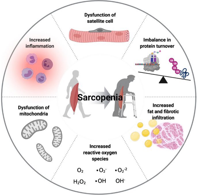 Omid_HopeUni's tweet photo. Sarcopenia: age-related loss of skeletal muscle mass &amp; function👇🏼

>reduced regenerative capacity
>imbalance in protein turnover
>alteration of muscle’s fat composition
>increased reactive oxygen species
>mitochondrial dysfunction 
>increased inflammation

https://t.co/LwWqQaMRlE https://t.co/rwzMCZzAp8