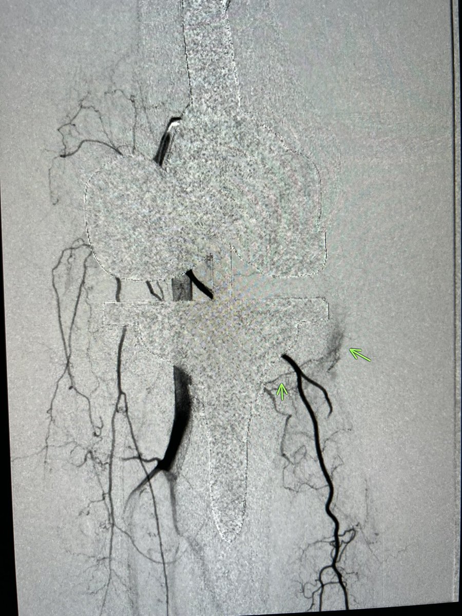 ChengaziMD's tweet image. Post #TKR #GAE anatomy can be very difficult. First time with protective coil #embo to divert flow/protect muscle and first time seeing active pooling in effusion. #VIRad #pain #OrthoTwitter #MedTwitter