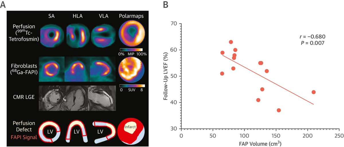 Total body #cvPET: The next generation of #cvImaging and #cvNuc? There are new opportunities for studying the entire cardiovascular system including insights into research in myocardial flow, blood pool and total body metabolism. bit.ly/45GnQWm #JACCIMG @SimonRCherry