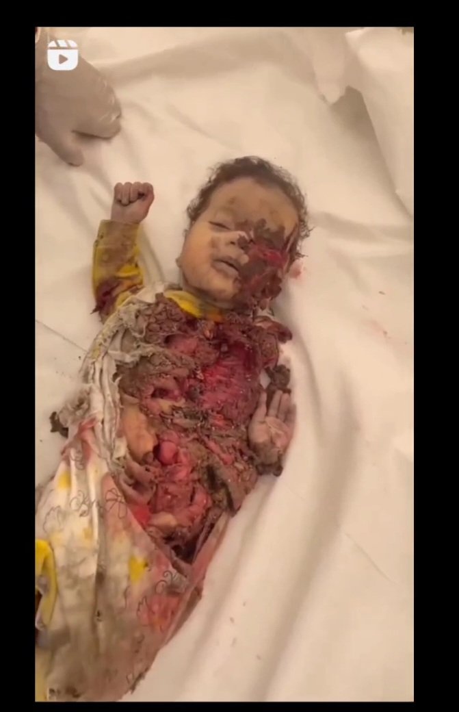 Barakat_fmc's tweet photo. @bnoble4ever @FoxNews This is what happens to children in Gaza and what the American and Western media hide https://t.co/JoljhTBSAf