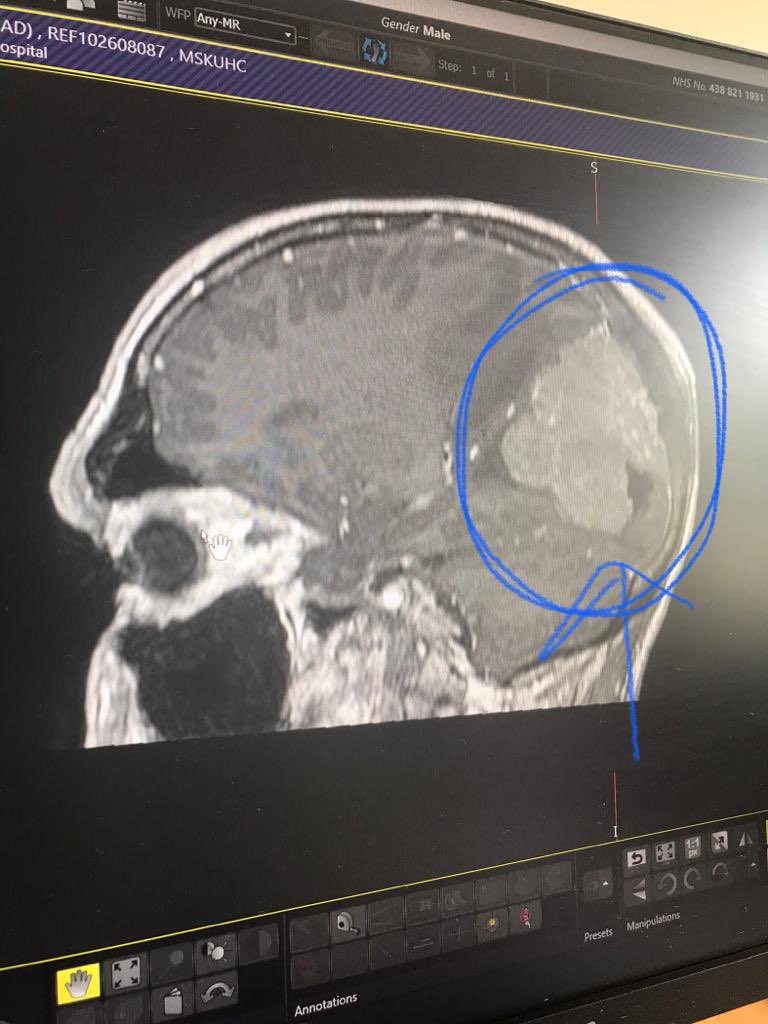 russandchips's tweet photo. That’s the brain tumour. 15 years it had been growing there, slowly shutting me down, but I was lucky when many more aren’t.
Please sign the petition to ensure that more money is allocated to research:

https://t.co/rSd3YIrAKD https://t.co/xtDPzuk1Vi