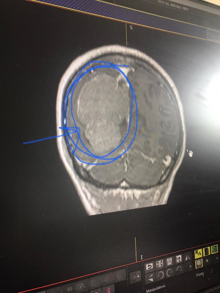 russandchips's tweet photo. That’s the brain tumour. 15 years it had been growing there, slowly shutting me down, but I was lucky when many more aren’t.
Please sign the petition to ensure that more money is allocated to research:

https://t.co/rSd3YIrAKD https://t.co/xtDPzuk1Vi