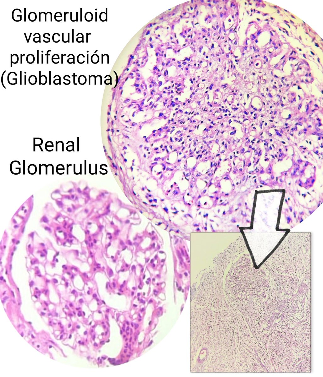 Compare and contrast between vascular proliferation of Glioblastoma and a renal Glomerulus. The most glomeruloid looking I've seen (today's case). #neuropath