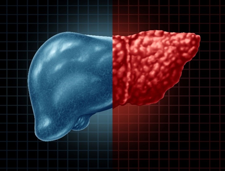 Up to 70% of people with type 2 diabetes have #NAFLD. On #NYPAdvances, @DBrandmanMD discusses how screening through primary care providers can help detect patients at high risk for fatty liver disease. nyphosp.co/3S4v9Eg @ColumbiaMed, @WeillCornell #ThinkLiverThinkLife