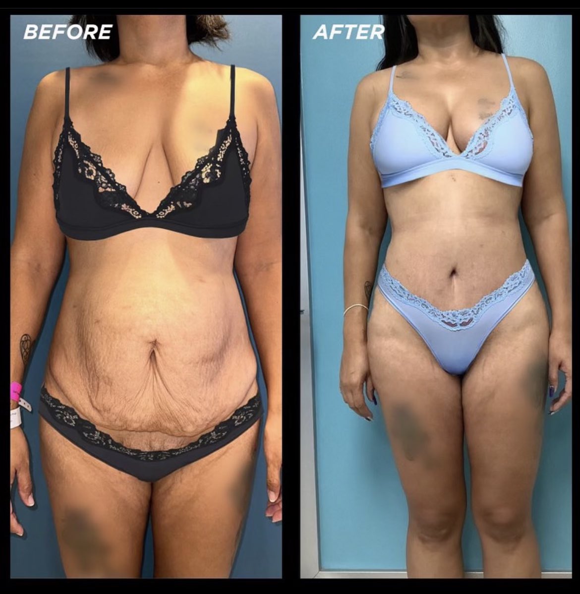 Dr. Miami on X: Whatcha guys think of my patient's tummy tuck