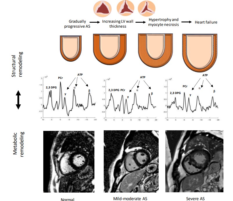 AS also causes metabolic remodeling of the myocardium. A gradient of myocardial energetic deficit & steatosis exists across the hypertrophied LV, & the metabolic changes precede irreversible LV remodeling & subclinical dysfunction @shvetamonga ahajrnls.org/3QmAyVK