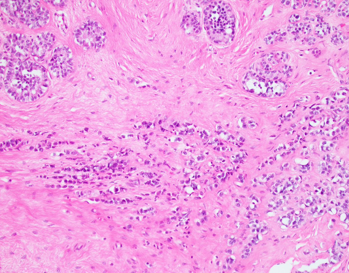 Hot off the press.

What is your diagnosis?

@wusm_pathology <a href="/washupathedu/">WashU Medicine Pathology & Immunology Education</a> #breastpath #PathTwitter #PathX #pathology