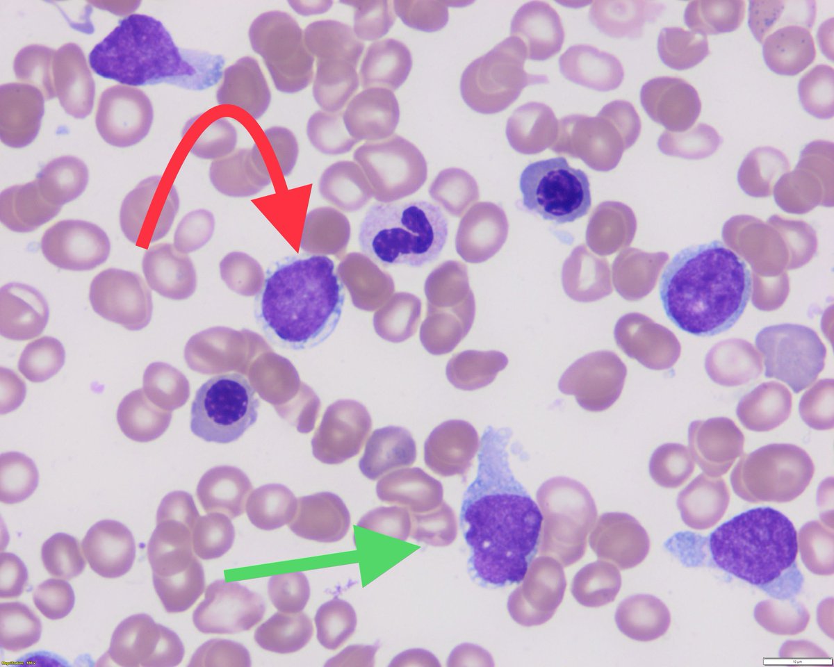 Not your mother’s pearl necklace (red) or hand mirror (green) … But pretty good buzz words/pics for your #hematology #hemepath Boards #BPDCN #hemepath