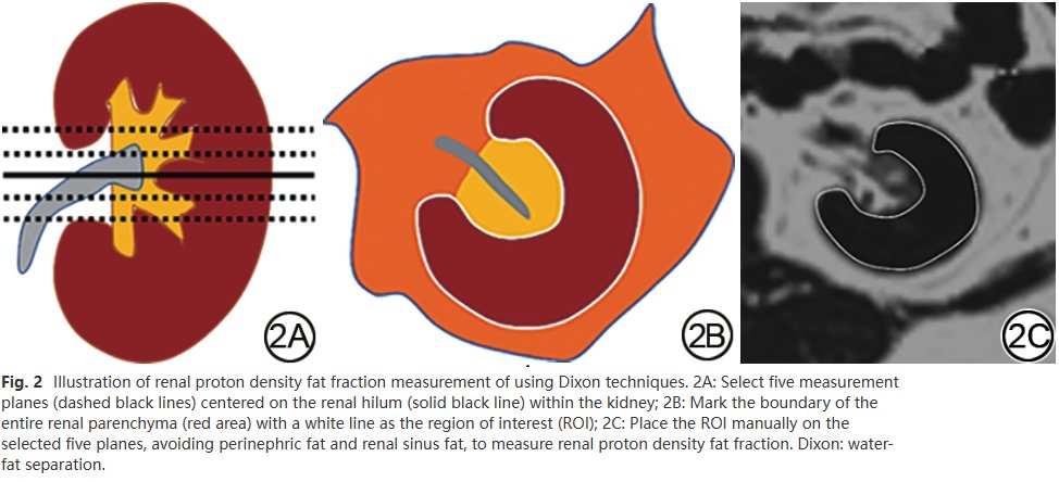 CJMRI_2010's tweet image. #Dixon-based #PDFF is more responsive to increased renal ectopic fat accumulation (RELA) and renal function impairment in patients with #T2DM than #HISTO MRS-based PDFF.
#MRI #DiabeticNephropathies #LipidAccumulation
med-sci.cn/cgzcx/article/…