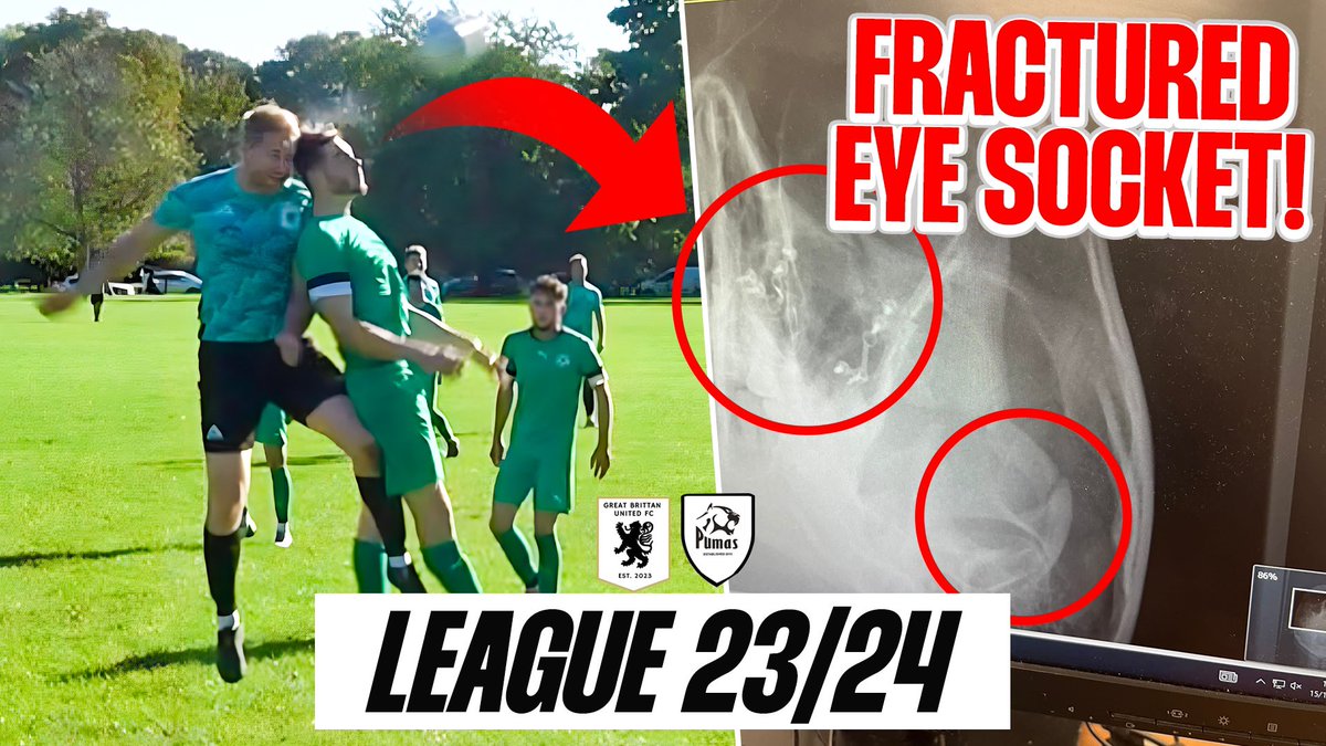 Absolute belter from this Sunday 👀 🎬🍿

Players eye socket fractured during a 7-0 win against top of the league and <a href="/BrittanToby/">Toby Brittan</a> came off injured 10 mins in 😅🤐

<a href="/Greatbrittanutd/">Great Brittan United</a> ⚽️

youtu.be/CQvfBGcuJJ0