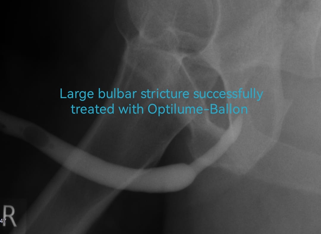 OTosev's tweet photo. Large bulbar stricture that was successfully treated with #Optilume by https://t.co/Kp4p9GaadA.univ.Georgi #Tosev https://t.co/yJj8OoBfBv