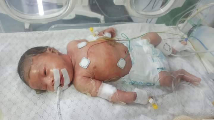 وزارة الصحة: إصابة طفل بعمر يومين بحروق واختناق خلال استهداف طيران الاحتلال لمنزل بمنطقة تل السلطان برفح فجر اليوم.