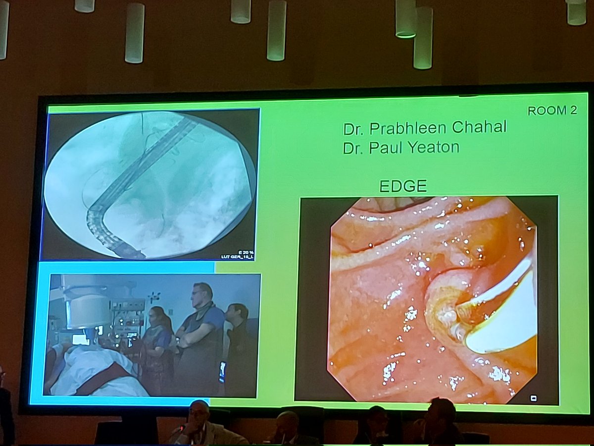 Belenmm271's tweet photo. Very nice Endoscopic ultrasound-Directed transgastric ERCP (EDGE) procedure performed by the brilliant @ChahalPrabhleen  at #ValladoLIVE2023. It couldn't start better 😍 #WomeninEndo https://t.co/naXx3dmFJq