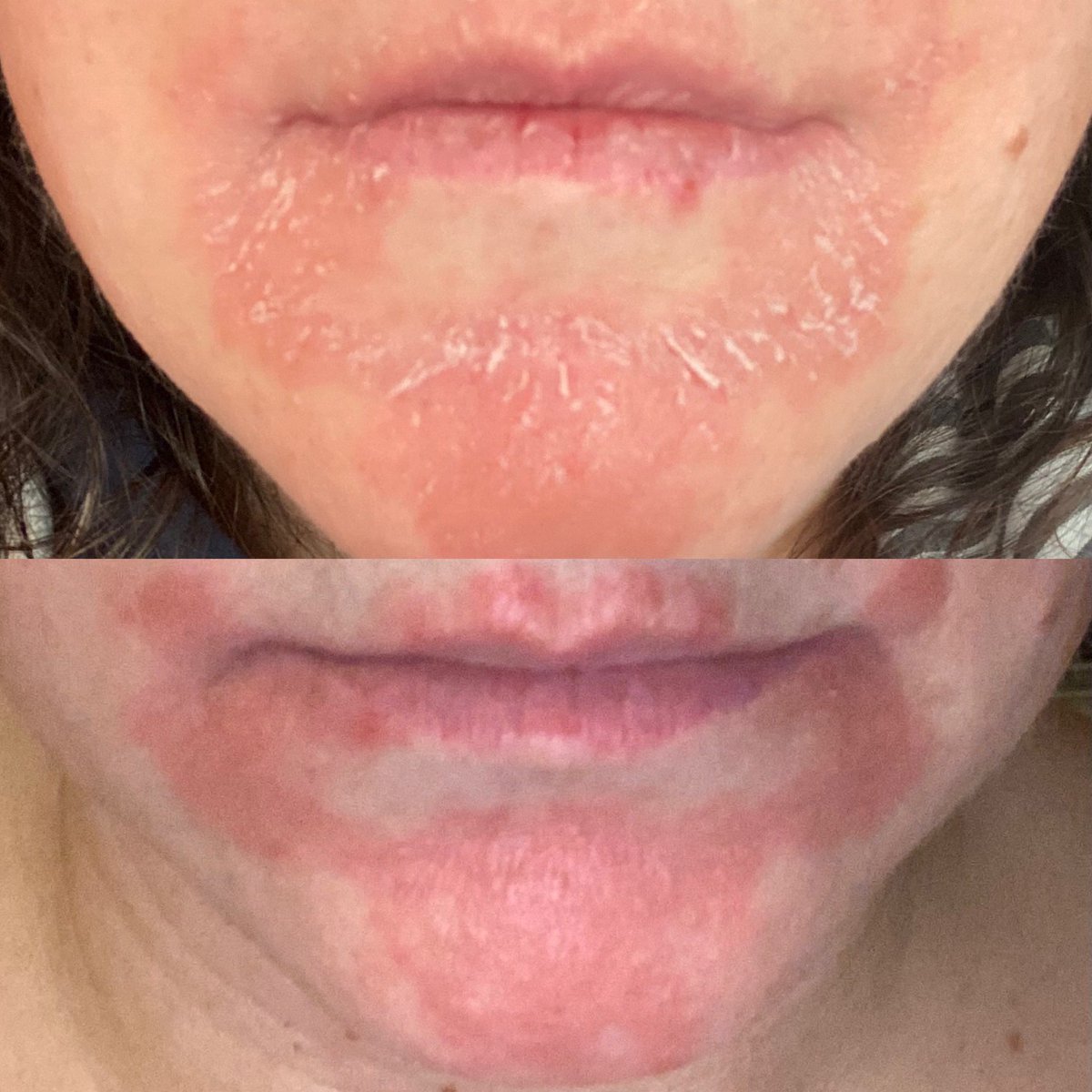 Patient with 1 year history of rash around the mouth. What’s the diagnosis? #TwitterConsult #WithConsent