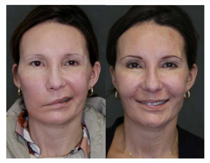 NewYorkFPC's tweet image. BEFORE: This female patient suffered from flaccid facial palsy after her 2nd brain surgery for vestibular schwannoma.

AFTER: The after photo shows her results after nerve grafting.

#beforeandafter #facialparalysis #facialnerve