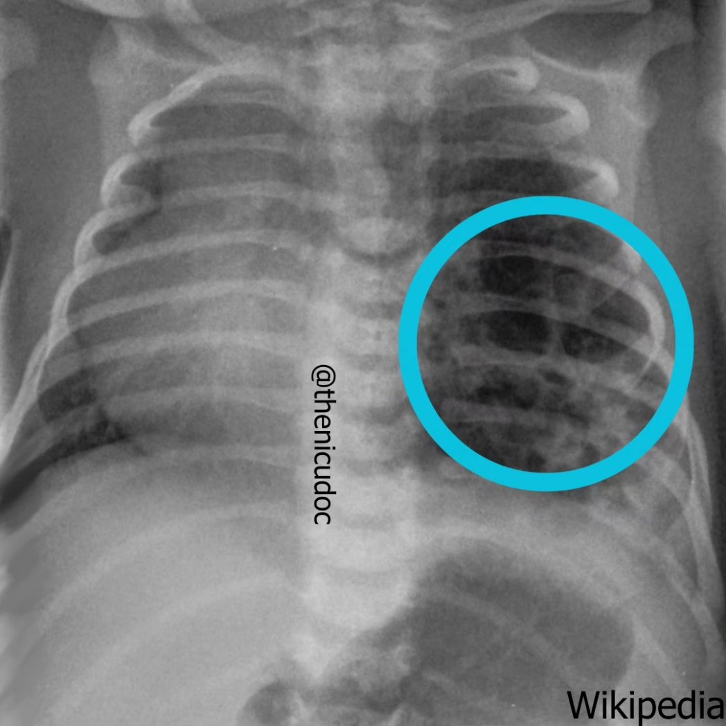 thenicudoc's tweet photo. CPAM, is a rare condition where abnormal lung tissue forms cysts or masses instead of normal lung tissue. CPAM can affect one or multiple lobes of the lung. It is usually present at birth and can cause respiratory symptoms, such as difficulty breathing or frequent infections. https://t.co/MlEOEdrNNc