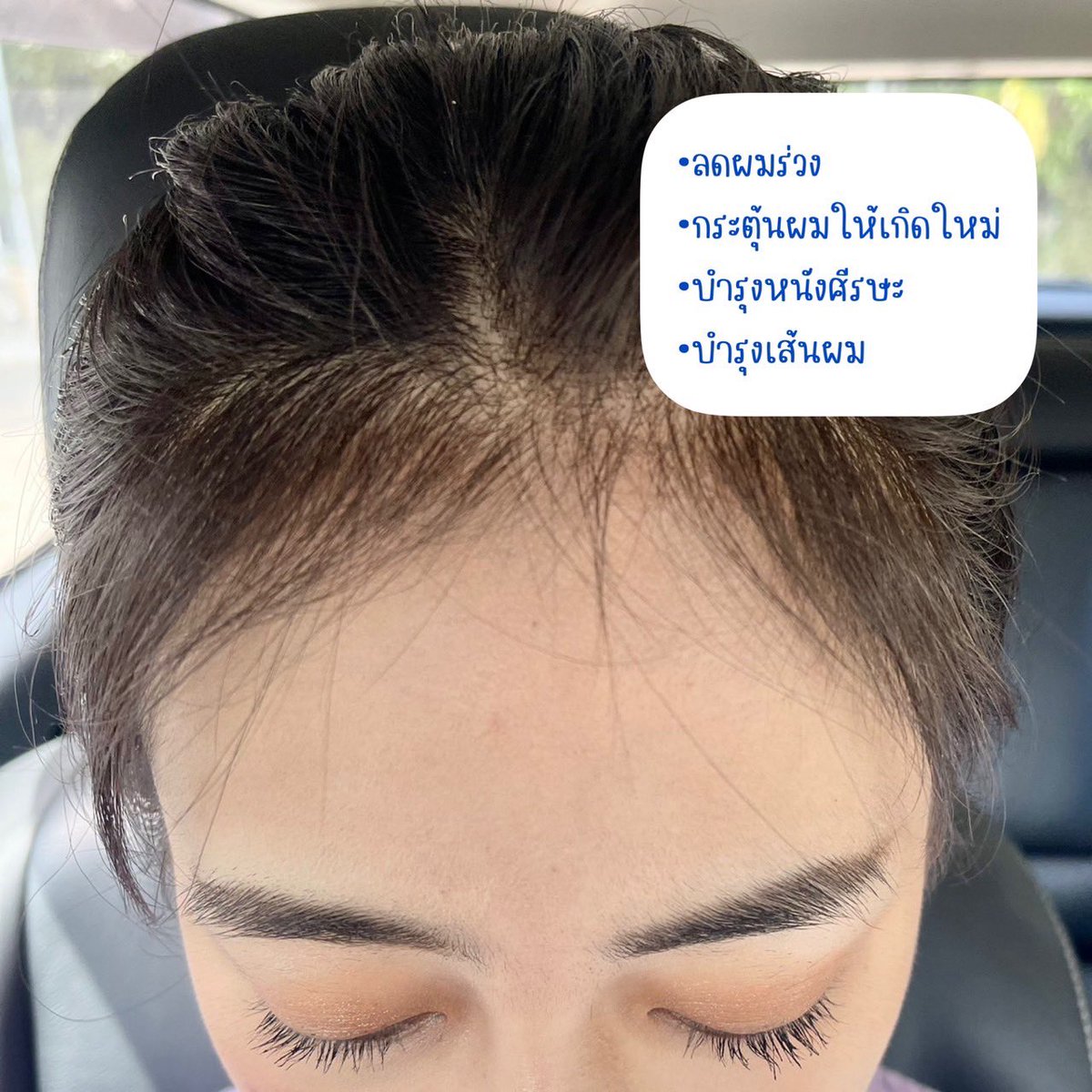 luknamyani's tweet photo. เมื่อก่อนผมบางมาก ต้องใส่แฮร์พีชประจำอะ แต่ล่าสุดเพื่อนทัก! ทำไมลูกผมเยอะจัง🤣เลยแนะนำวิตามินผม HERA ของหมอทิว เค้าช่วยให้เส้นผมแข็งแรง ลดผมขาดหลุดร่วง นี่จากที่ผมหลุดเป็นกำอะ ตอนนี้แทบไม่มีละ ทาน1เม็ดก่อนนอน ปุกเดียวเห็นผล!💙 #mortiw #หมอทิว #HERA #ผมบาง #ผมร่วง #บำรุงหนังศรีษะ https://t.co/KECE3KxmQM