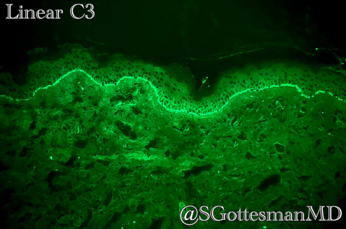 How often do you recommend direct immunofluorescence when you see eosinophils tagging at the dermo-epidermal junction. Answer: pretty much always. Nice example of linear C3 in gestational pemphigoid. #dermpath #dermtwitter #SilviPearls #pathology