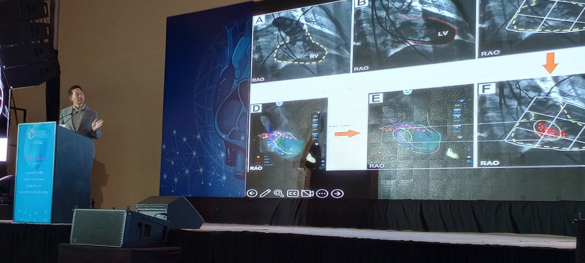 Dr. Márcio Figueiredo EP (@figueiredo_ep) on Twitter photo Starting the day with nice tips for conduction system pacing... Learning a lot from <a href="/DrRoderickTung/">Roderick Tung</a> ! <a href="/LAHRSonline1/">LAHRS</a> <a href="/HRSonline/">Heart Rhythm Society</a> Session, #LAHRS2023 Starting the day with nice tips for conduction system pacing... Learning a lot from <a href="/DrRoderickTung/">Roderick Tung</a> ! <a href="/LAHRSonline1/">LAHRS</a> <a href="/HRSonline/">Heart Rhythm Society</a> Session, #LAHRS2023