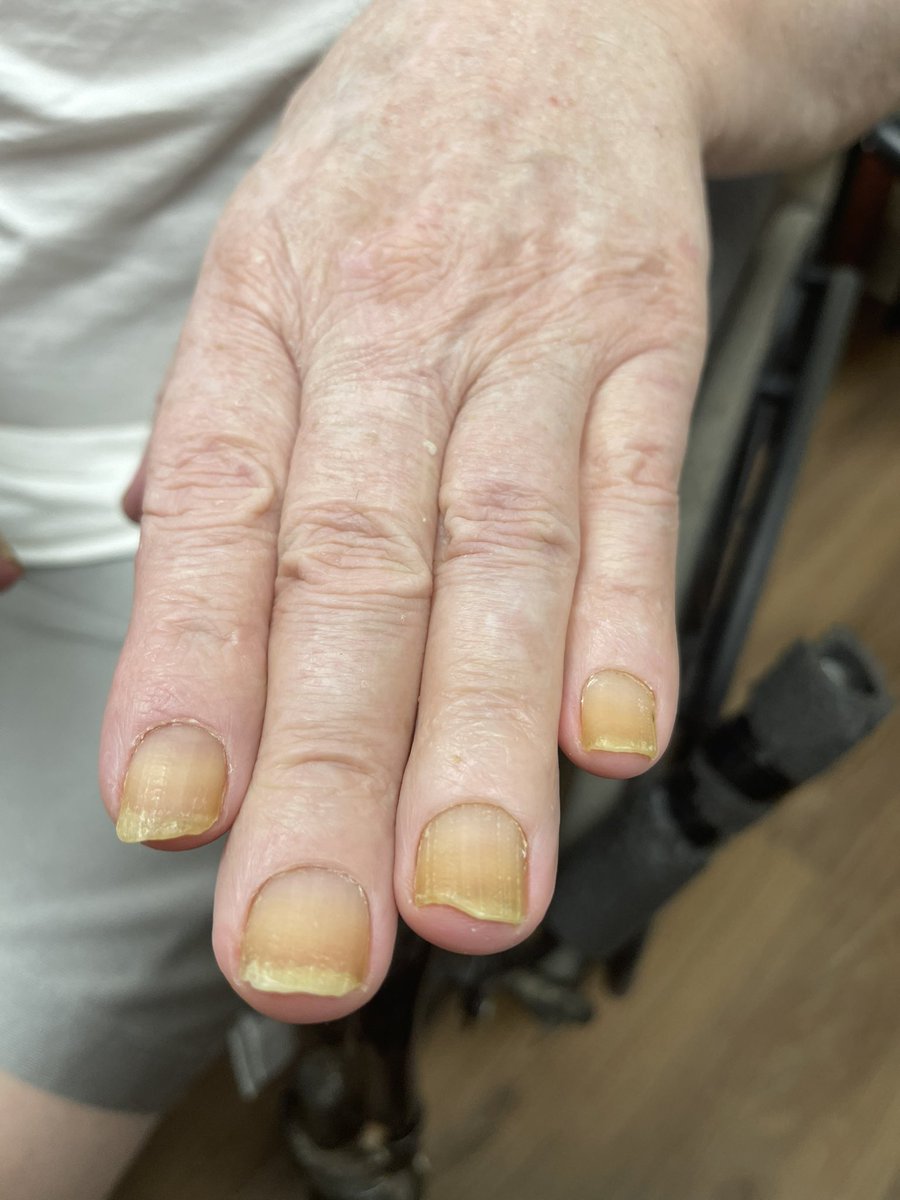 DrJxFL's tweet photo. 📢 Hey @pams_web, @AAPPHealth, and @aafp! 🌼🔬 Have you heard about the Yellow Nail Syndrome? Today I saw this rare condition at my clinic characterized by yellow, thickened, and slow-growing nails, along with other associated symptoms. The exact cause of this syndrome is unknown, but it's believed to be related to lymphatic system dysfunction. Please share all other differentials 🌟 #YellowNailSyndrome #RareConditions #HealthInfo
@pams_web @AAPPHealth @aafp