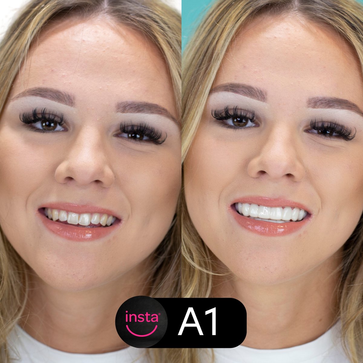 instasmile's tweet image. Lilly's A1 instasmile really brightens up her whole face, and we love her whiter, straighter look! Want whiter, straighter-looking teeth of your own? Head to the link in our bio and start your smile journey today! 😁

#Smile #NewSmile #Veneers #ClipOnVeneers #SmileTransformation